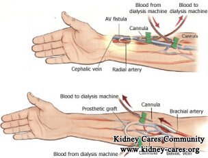 How Bad Is the Fistula Surgery for Kidney Failure Patients