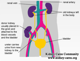 Failed Kidney Transplant, Creatinine 7, Edema, Urine Output: How to Treat