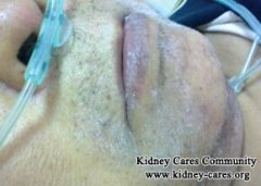 Why Is There Uremic Frost in Renal Failure