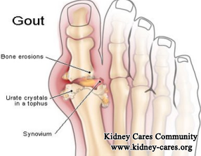 How Does Gout Link To PKD