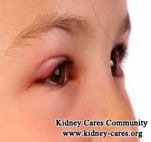What Should Do With Puffy Eyes In Kidney Failure