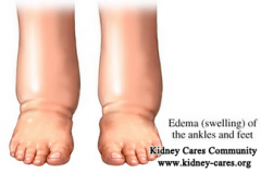 How Does One Kidney Failure Patient Deal With Swelling Of The Feet And Ankles