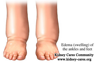 How Does One Kidney Failure Patient Deal With Swelling Of The Feet And Ankles