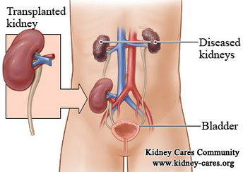 Will PKD Go Away After Kidney Transplant