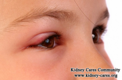 Why Is There Eyelid Swelling In Kidney Disease
