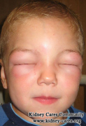 How Can I Reduce Facial Swelling From Nephrotic Syndrome