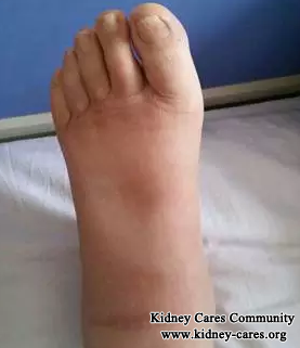 Chinese Medicines For Puffy Feet In Membranous Nephropathy