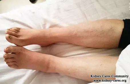 Chinese Medicines For Puffy Feet In Membranous Nephropathy