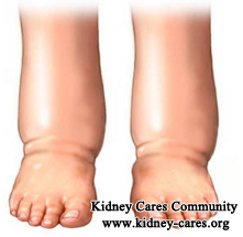 Can I Treat Swelling On Ankles In Stage 3 Kidney Disease