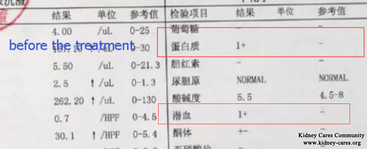 Shijiazhuang Kidney Disease Hospital Treats My Purpura Nephritis With No Relapse