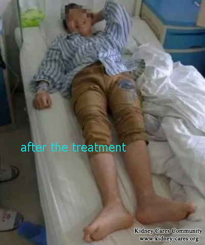 Shijiazhuang Kidney Disease Hospital Treats My Purpura Nephritis With No Relapse
