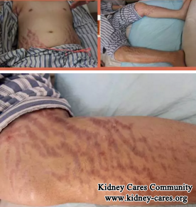 Nephrotic Syndrome, Severe Edema: Four One Chinese Medicine Treatment