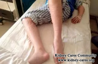 Nephrotic Syndrome, Severe Edema: Four One Chinese Medicine Treatment