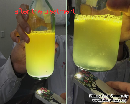 Comparison Before and After Treatment In Diabetic Nephropathy