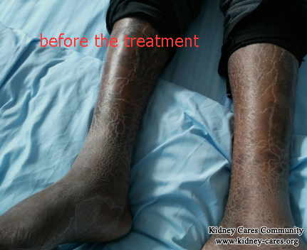Comparison Before and After Treatment In Diabetic Nephropathy