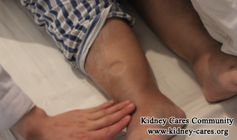 Urine Protein 2+, Serum Creatinine 1004umol/L, Swelling In Uremia: What To Do