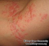 Do Patients with Polycystic Kidneys Get Skin Rashes