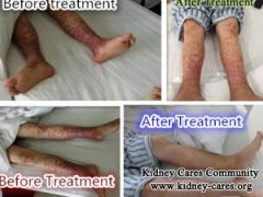 What Should I Do with Swollen Feet and Stomach with Lupus Nephritis