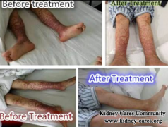 Purpura Nephritis Is Treated Well By Chinese Medicine Treatment