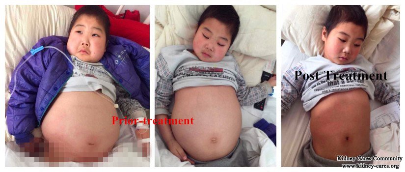 Chninese medicine treatment for nephrotic syndrome to control the edema 