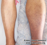 How to Control Edema for Hypertensive Nephropathy