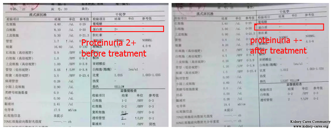 Proteinuria 2+ Not Controlled for 7 Years, Chinese Treatment Help Reuduce to ±