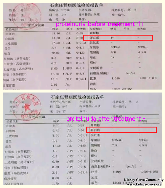 IgA Nephropathy: Serum Creatinine Level Reduced From 697 to 173 With Chinese Treatment