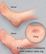 What To Do For Swelling from Nephrotic Syndrome
