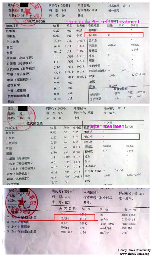 Chinese Medicine Treatment Avoid Relapse of Nephrotic Syndrome Without Steroids