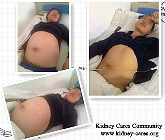 Big Stomach Disappears In Nephrotic Syndrome Patients
