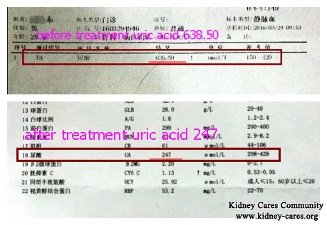 More Than 200 Stones Discharged From Kidneys, It is a Real Story