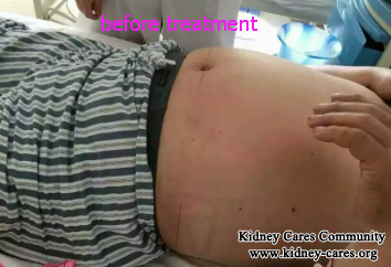 Swelling Disappears, High Creatinine Level Reduces After 15 Days Chinese Treatment