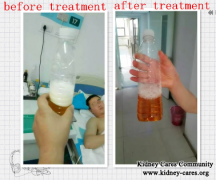 Foamy Urine From CKD Is Alleviated Effectively By Our Toxin-Removing Treatment
