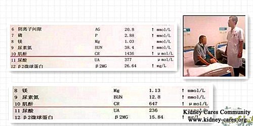 High Creatinine Level Is Reduced to 647 From 1436