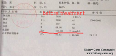 What Is The Good Option for Treating PKD