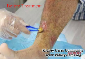 Toxin-Removing Treatment For Purpura Nephritis In Shijiazhuang Kidney Disease Hospital