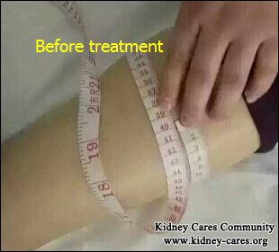 How to Relieve Leg Swelling for Diabetic Nephropathy Patients