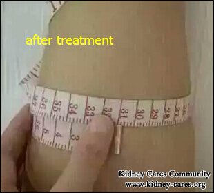 How to Relieve Leg Swelling for Diabetic Nephropathy Patients