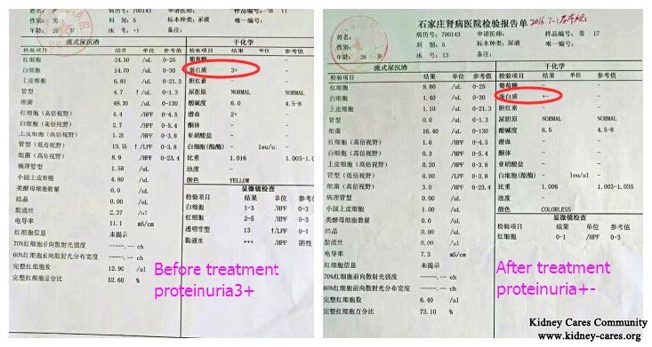 toxin-removing treatment for protein in urine, nephrotic syndrome treatment 