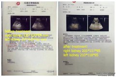 PKD: Enlarged Kidneys Shrunk After Taking Chinese Treatment