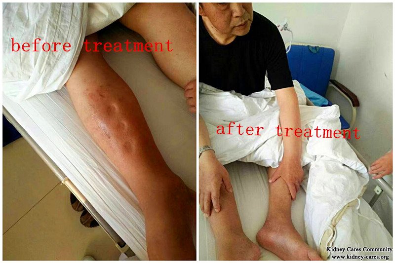 Chinese medicine treatment for swelling in kidney failure,kidney failure treatment 
