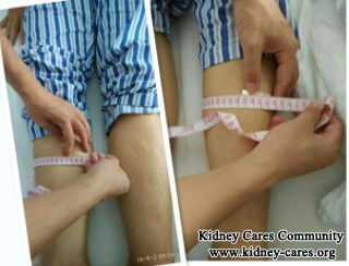 Body Weight Reduces 5kg In Uremia Patients