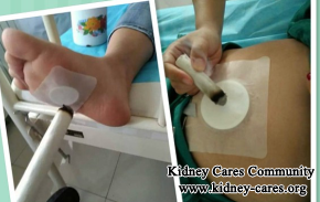 Is Umbilical Therapy Effective For Proteinuria In IgA Nephropathy