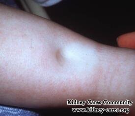 How Oedema Can Be Improved in Nephropathy
