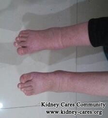 How Can Dialysis Patients Bring down Swollen Feet and Ankles