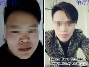 It Is Important To Find The Root Treatment For Nephrotic Syndrome