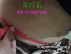 Reject Steroid Therapy for Nephrotic Syndrome