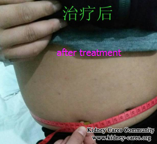 Steroid Therapy for Nephrotic Syndrome 