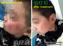 Lupus Nephritis 8 Years, Get A Good Treatment In Our Hospital