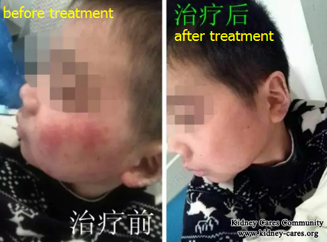 Treatment for Lupus Nephritis In Our Hospital 